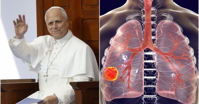 Plaučių vėžys gali ilgai slėptis: medikai įspėja, kad rizikuoja ne tik rūkantys